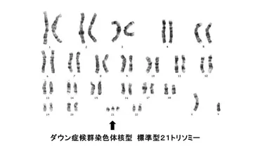 ダウン症候群