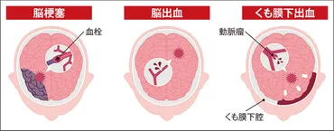 深刻な血管病「くも膜下出血」 原因の約80%が脳動脈瘤破裂