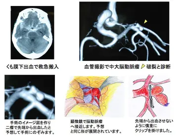 くも膜下出血