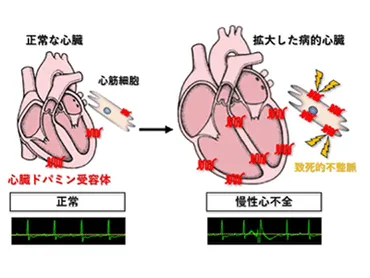 慢性心不全患者に起こる「突然死」の原因を解明、世界初－東大病院ほか 