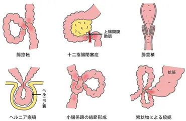 腸閉塞（イレウス）