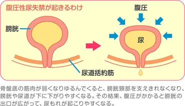 腹圧性尿失禁