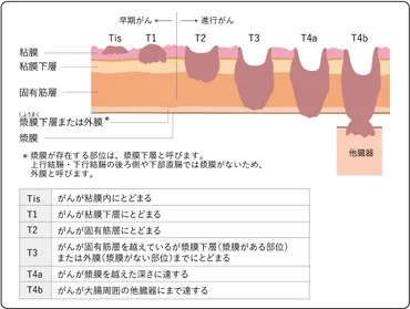 大腸がん、あなたは大丈夫？早期発見がカギ!!