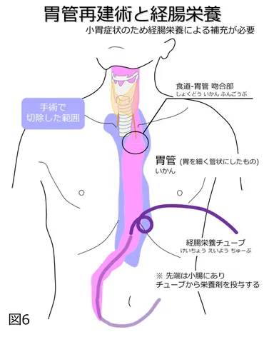 食道がんについて 