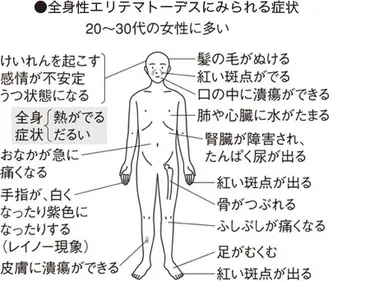 膠原病って、一体ナニ？とは！？