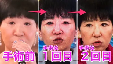 和田アキ子の眼瞼下垂手術：成功への道のり？公開されたその舞台裏とは！？