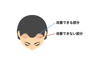 医師監修】生え際の後退や薄毛に育毛剤は効果ある？育毛剤の選び方＆使い方 