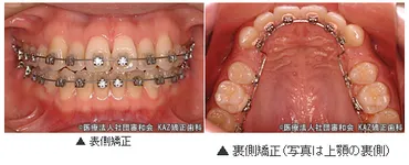 裏側矯正と表側矯正の比較 