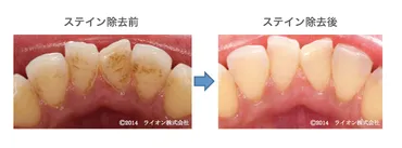 歯の着色汚れ（ステイン）の原因は？効果的な歯みがき法でステインを予防！ 