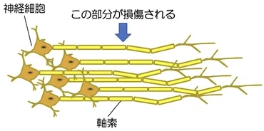 Neuroinfo Japan：びまん性軸索損傷