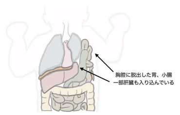 出生前診断しておきたい「先天性横隔膜ヘルニア」という病気 – よりおか胎児クリニック ブログ