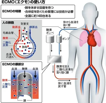 ECMOってどんな治療法？最後の手段とは！？