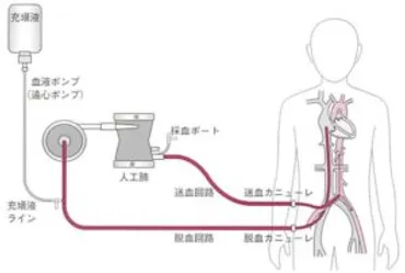 ECMO回路の仕組みと構成要素について