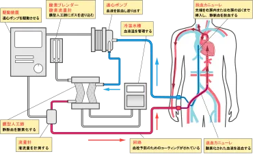 経皮的心肺補助法（PCPS）の原理・効果、装置・回路の仕組み、適応・禁忌 