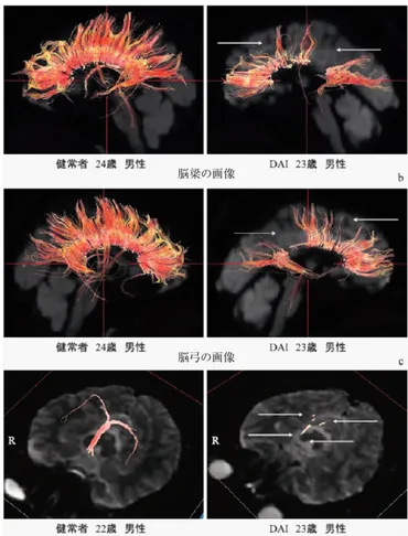 むち打ちで脳が傷つく〜MRIに映らない脳損傷MTBI(軽度外傷性脳損傷)」の本をクラウドファンディングで出版、販売開始。 