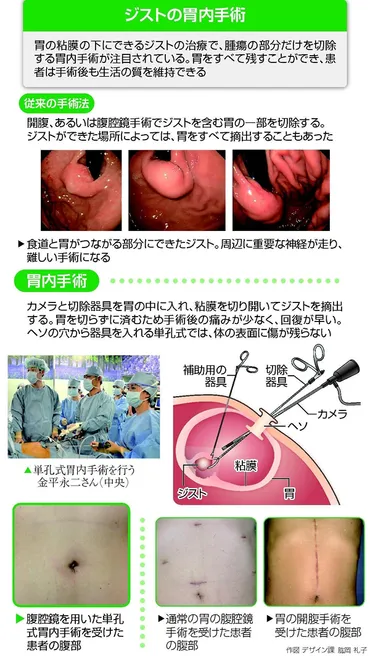 ジスト手術に新手法…胃の内側 腫瘍だけを切除 