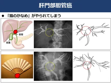 胆道がん