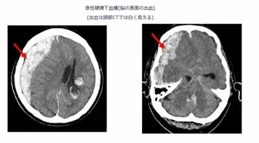 急性硬膜下血腫は「死亡率6割超、難しい手術」 鳥山明さん死去 ...