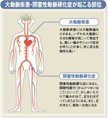 大動脈瘤の破裂はショック死に至る！大動脈疾患 