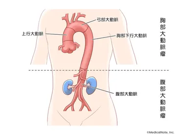 胸部大動脈瘤とはどんな病気？ ～約60％が破裂するまで無症状で進行する～ 