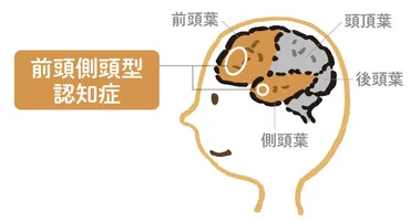 前頭側頭型認知症を専門医が徹底解説 家族へのアドバイスも 