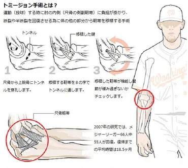 トミージョン手術とその後のリハビリ 