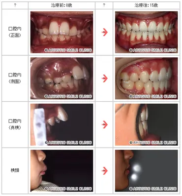 子どもの症例 その1：上顎前突（8歳～15歳） 