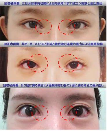 目頭切開術後の失敗修正＆傷跡の治療 