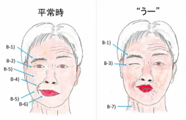 顔面神経麻痺とは？原因や症状、経過、治療について – 東京大学大学院医学系研究科 形成外科学分野