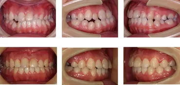 受け口（下顎前突）の歯並び矯正治療