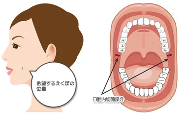 えくぼ形成 