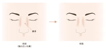 鼻骨骨切りの美容整形について 