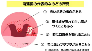 大人の「溶連菌」の症状や薬・検査について【放置するとどうなる？】 