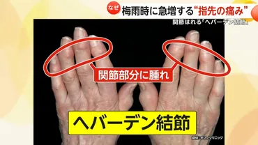 なぜ？】梅雨時に急増する゛指先の痛み゛ 関節腫れる「へバーデン結節」…国内で約300万人 ゛スマホの触りすぎ゛にも注意