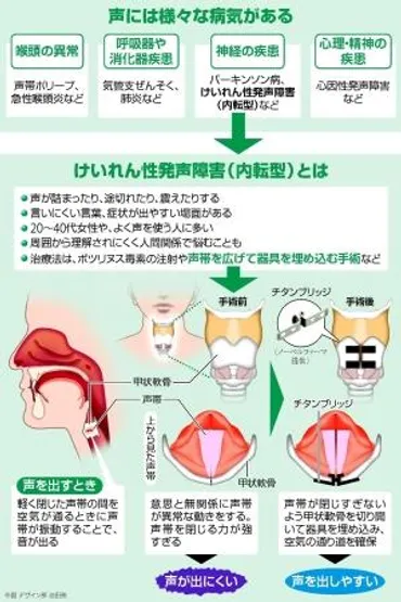 けいれん性発声障害…神経疾患 声出にくく 