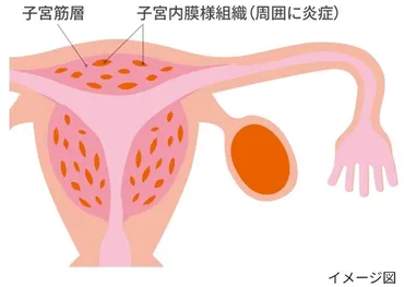 子宮腺筋症とは？診察と治療の内容、受診タイミング