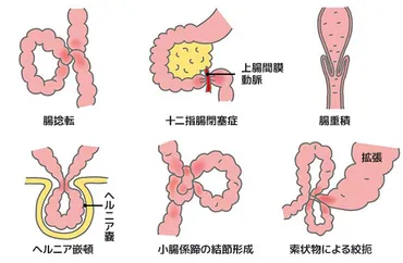 腸閉塞（イレウス）