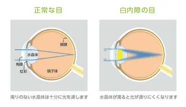 白内障とは？年齢に応じた症状・進行速度と対策、治療方法をわかりやすく