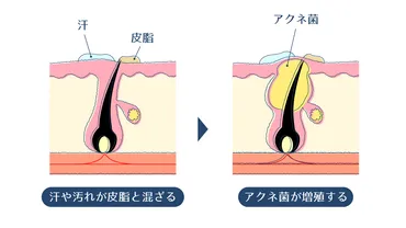 妊娠中のニキビの原因は何？肌荒れしやすい理由とおすすめスキンケア方法 