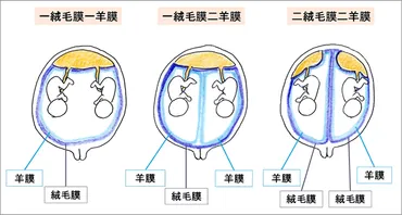 多胎妊娠 