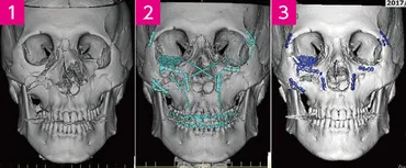 早期治療で、正確な整復を目指す 顔面骨骨折 