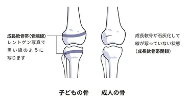 くる病ってホントに怖い？くる病の基礎知識とは！？