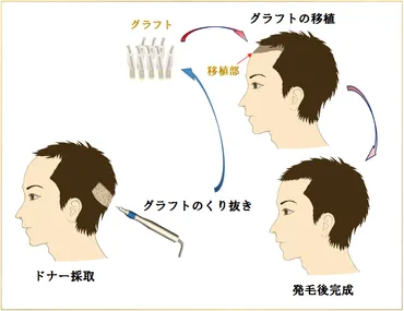 自毛植毛が安いおすすめクリニック9選！薄毛治療の料金や失敗しない選び方も解説！ 