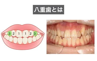 八重歯は矯正した方が良い？ 