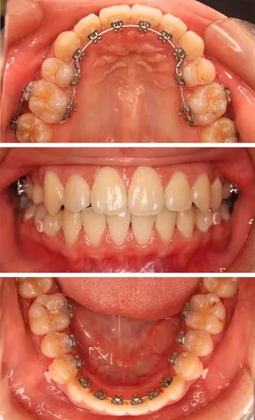 舌側矯正治療（裏側矯正） 